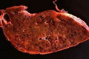 Parasites in the human liver